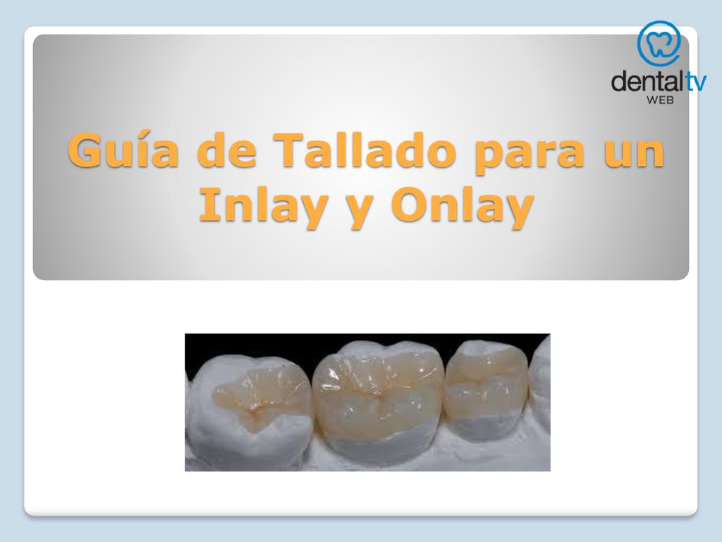 Guía de Tallado para un Inlay y Onlay