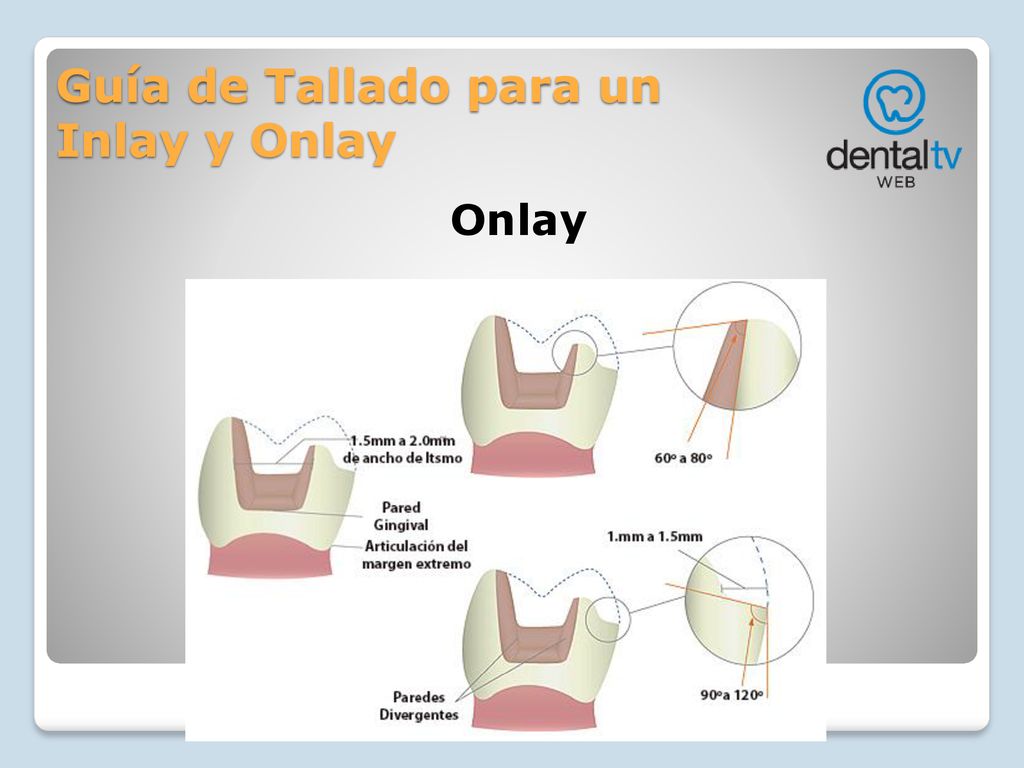 Guía de Tallado para un Inlay y Onlay