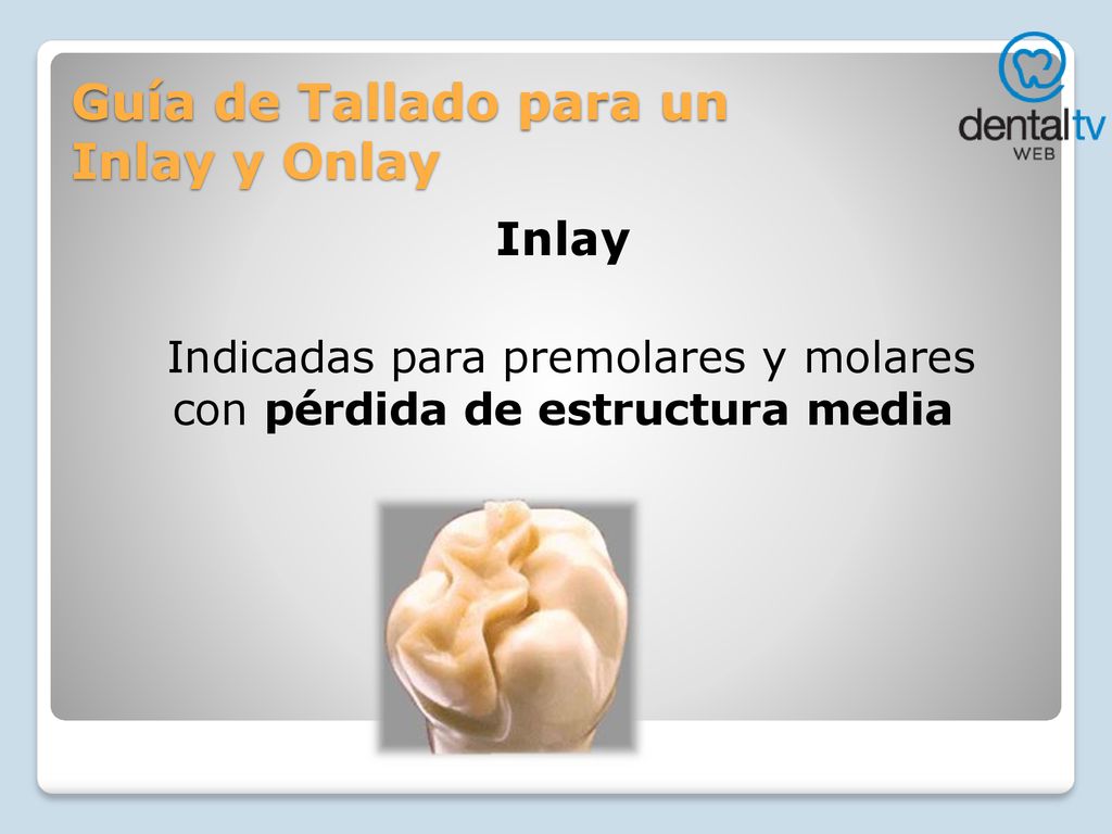 Guía de Tallado para un Inlay y Onlay