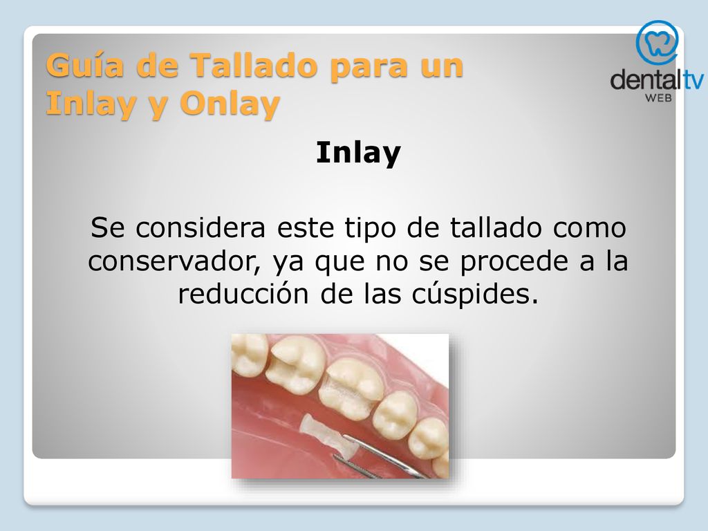 Guía de Tallado para un Inlay y Onlay