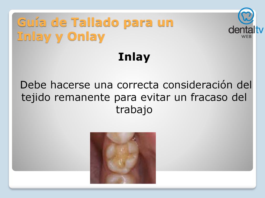 Guía de Tallado para un Inlay y Onlay