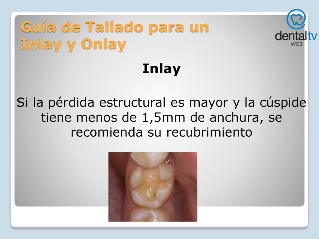 Guía de Tallado para un Inlay y Onlay