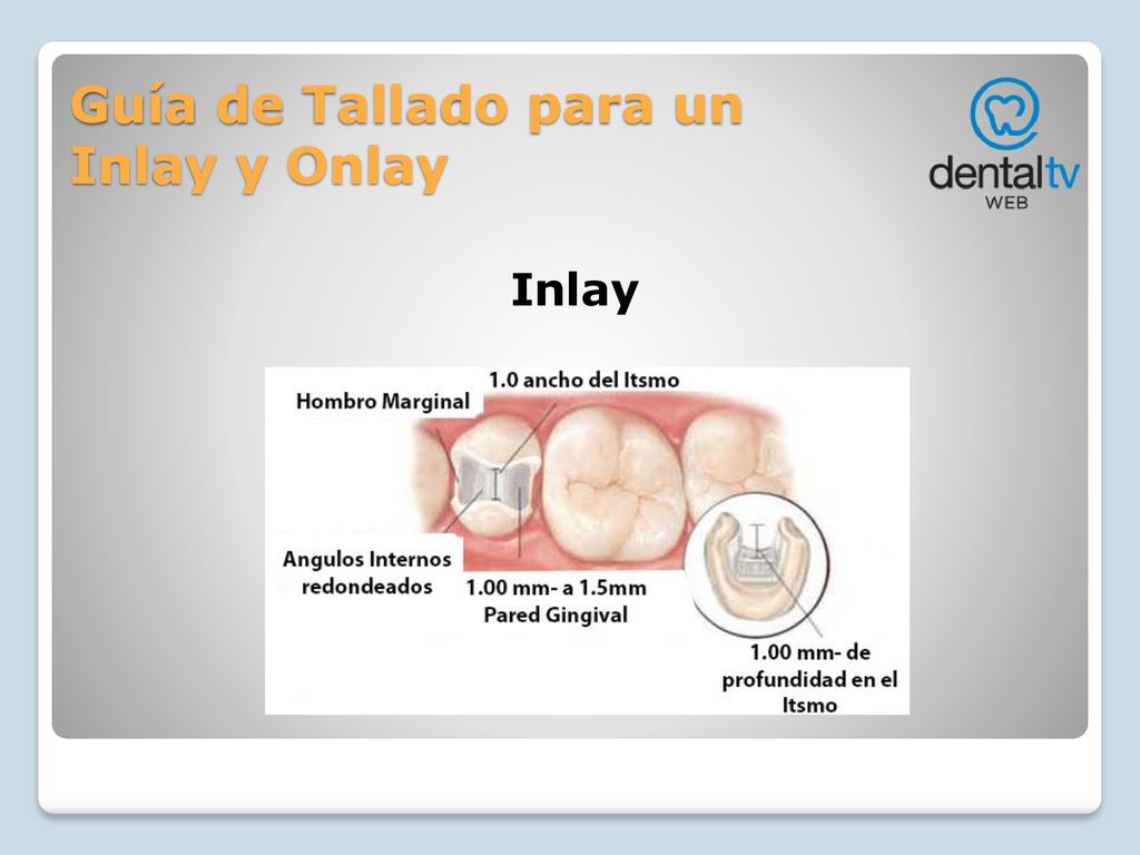 Guía de Tallado para un Inlay y Onlay