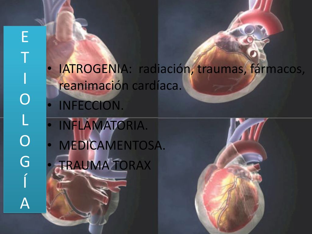 E T I O L O G Í A IATROGENIA: radiación, traumas, fármacos, reanimación cardíaca. INFECCION. INFLAMATORIA.