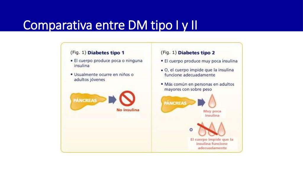 Comparativa entre DM tipo I y II