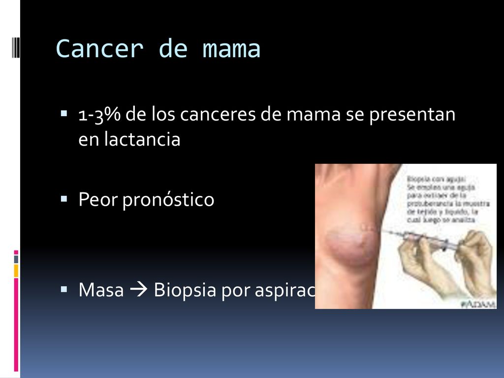 Cancer de mama 1-3% de los canceres de mama se presentan en lactancia