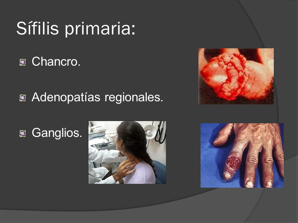 Sífilis primaria: Chancro. Adenopatías regionales. Ganglios.