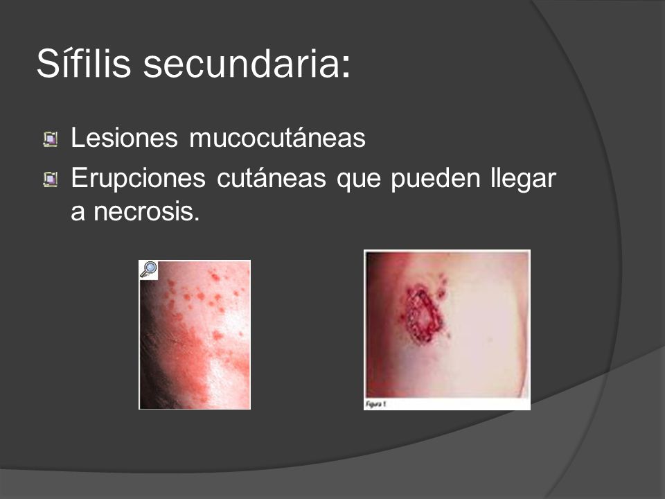 Sífilis secundaria: Lesiones mucocutáneas