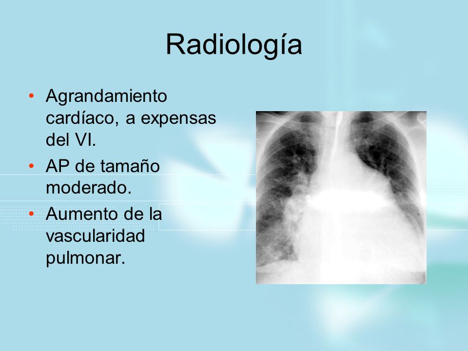Radiología Agrandamiento cardíaco, a expensas del VI.