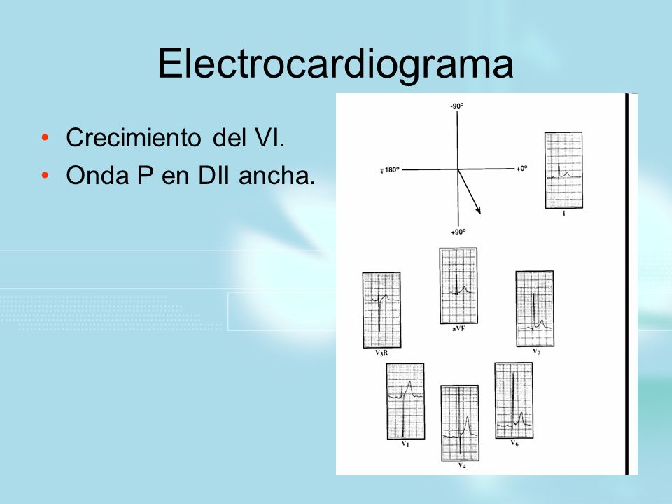 Electrocardiograma Crecimiento del VI. Onda P en DII ancha.