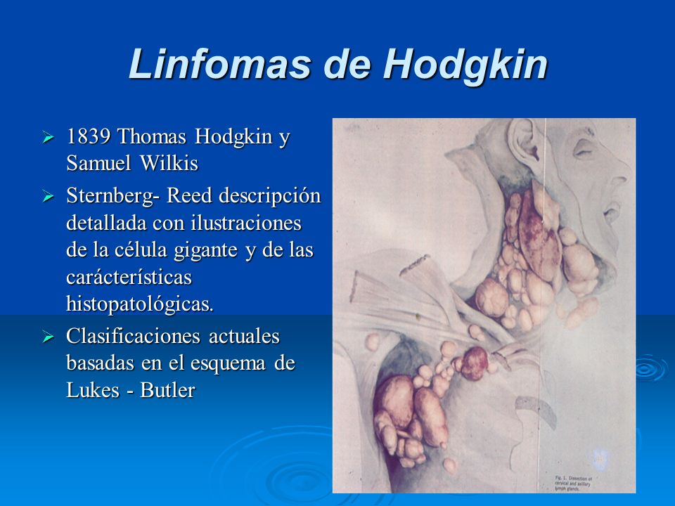 Linfomas de Hodgkin 1839 Thomas Hodgkin y Samuel Wilkis