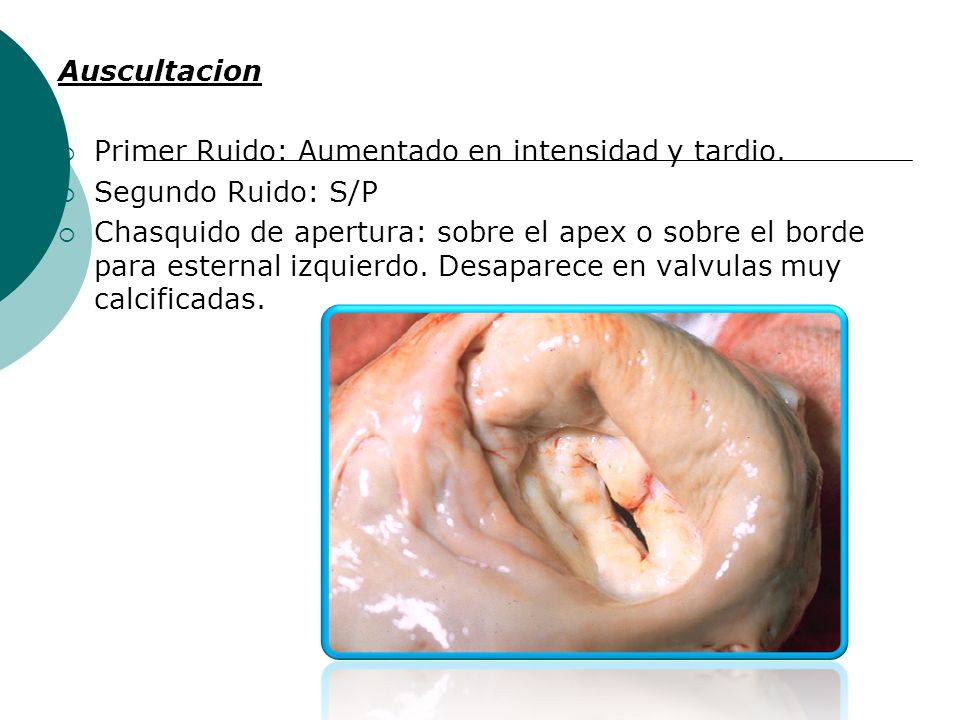 Auscultacion Primer Ruido: Aumentado en intensidad y tardio. Segundo Ruido: S/P.