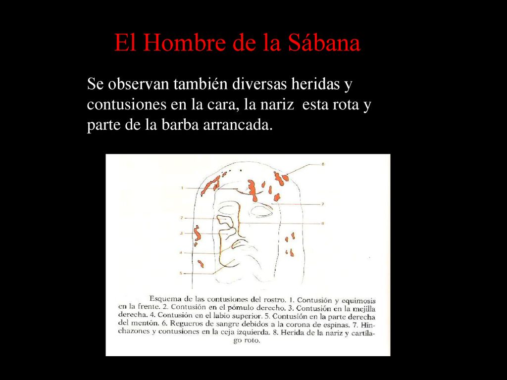 El Hombre de la Sábana Se observan también diversas heridas y contusiones en la cara, la nariz esta rota y parte de la barba arrancada.