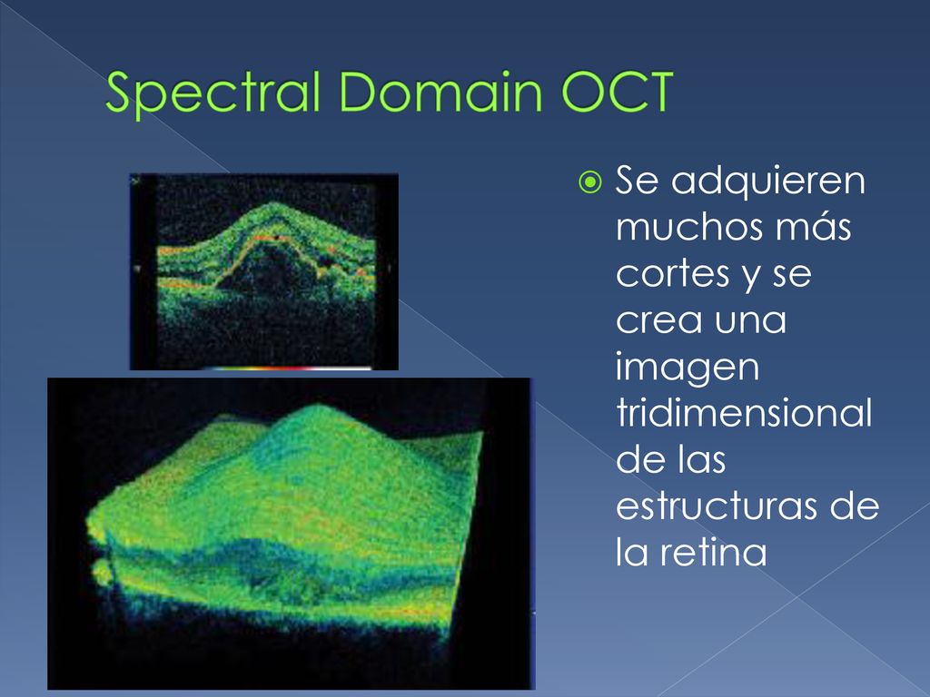 Spectral Domain OCT Se adquieren muchos más cortes y se crea una imagen tridimensional de las estructuras de la retina.
