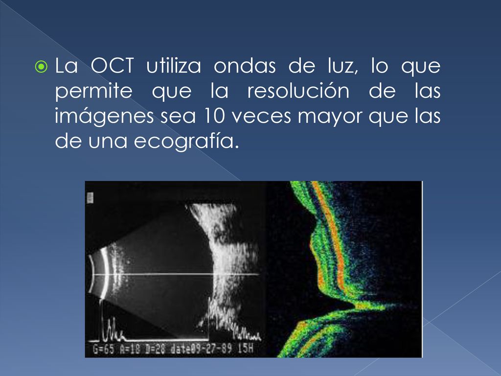 La OCT utiliza ondas de luz, lo que permite que la resolución de las imágenes sea 10 veces mayor que las de una ecografía.