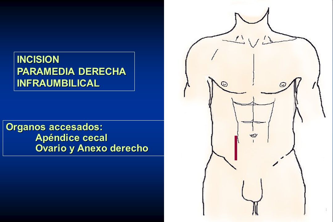 INCISION PARAMEDIA DERECHA INFRAUMBILICAL Organos accesados: Apéndice cecal Ovario y Anexo derecho