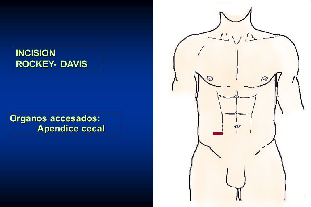 INCISION ROCKEY- DAVIS Organos accesados: Apendice cecal