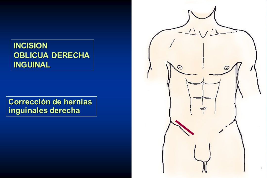 INCISION OBLICUA DERECHA INGUINAL Corrección de hernias inguinales derecha