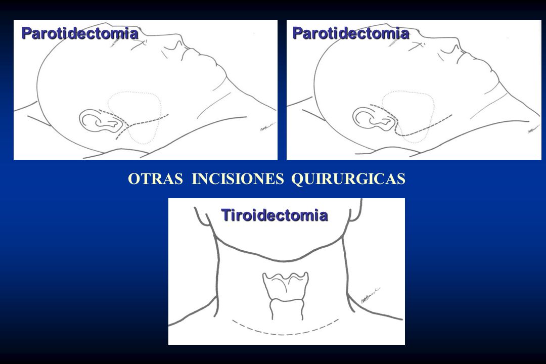 Parotidectomia Parotidectomia OTRAS INCISIONES QUIRURGICAS Tiroidectomia