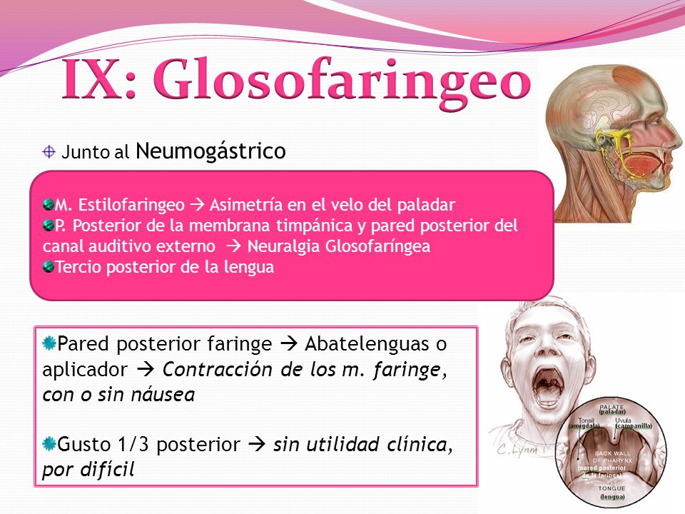 IX: Glosofaringeo Junto al Neumogástrico. M. Estilofaringeo  Asimetría en el velo del paladar.
