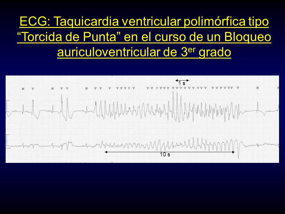 ECG: Taquicardia ventricular polimórfica tipo Torcida de Punta en el curso de un Bloqueo auriculoventricular de 3er grado