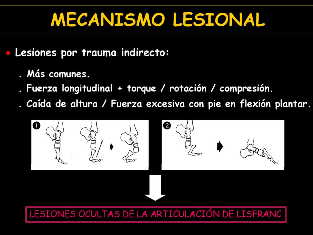 MECANISMO LESIONAL Lesiones por trauma indirecto:   . Más comunes.