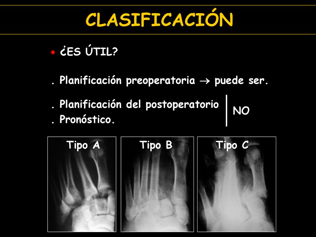CLASIFICACIÓN ¿ES ÚTIL . Planificación preoperatoria  puede ser.