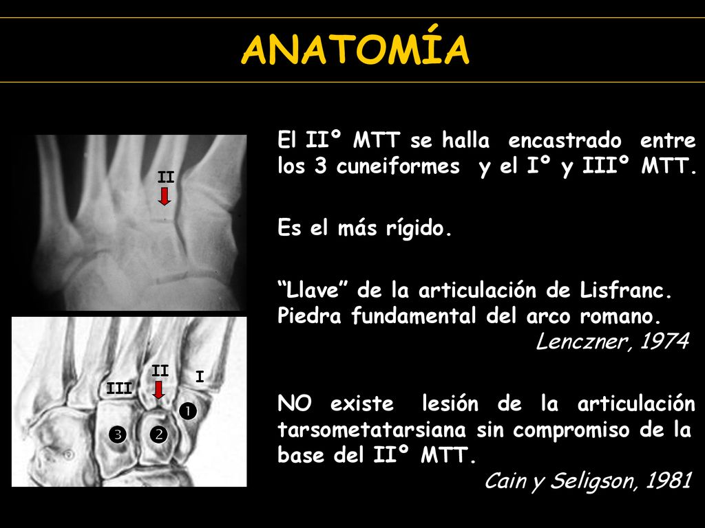 ANATOMÍA El IIº MTT se halla encastrado entre los 3 cuneiformes y el Iº y IIIº MTT. Es el más rígido.