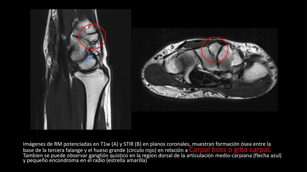 Imágenes de RM potenciadas en T1w (A) y STIR (B) en planos coronales, muestran formación ósea entre la base de la tercera falange y el hueso grande (circulo rojo) en relación a Carpal boss o giba carpal.