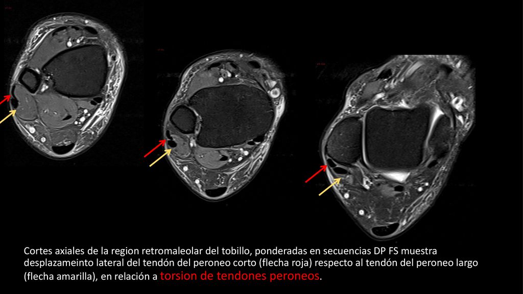 Cortes axiales de la region retromaleolar del tobillo, ponderadas en secuencias DP FS muestra desplazameinto lateral del tendón del peroneo corto (flecha roja) respecto al tendón del peroneo largo (flecha amarilla), en relación a torsion de tendones peroneos.