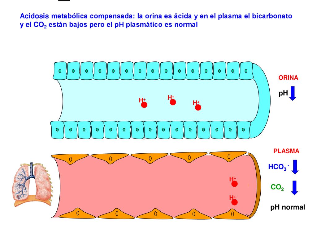 Acidosis metabólica compensada: la orina es ácida y en el plasma el bicarbonato y el CO2 están bajos pero el pH plasmático es normal