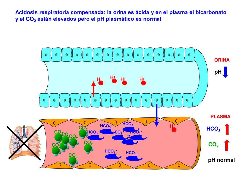 Acidosis respiratoria compensada: la orina es ácida y en el plasma el bicarbonato y el CO2 están elevados pero el pH plasmático es normal