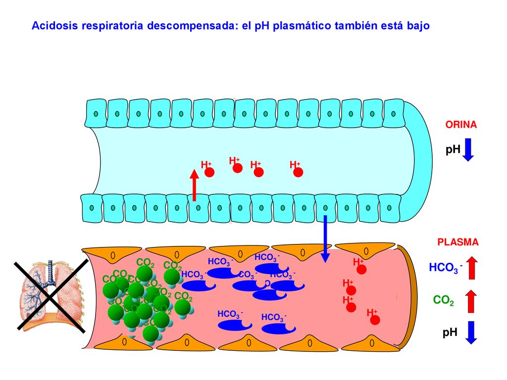 Acidosis respiratoria descompensada: el pH plasmático también está bajo