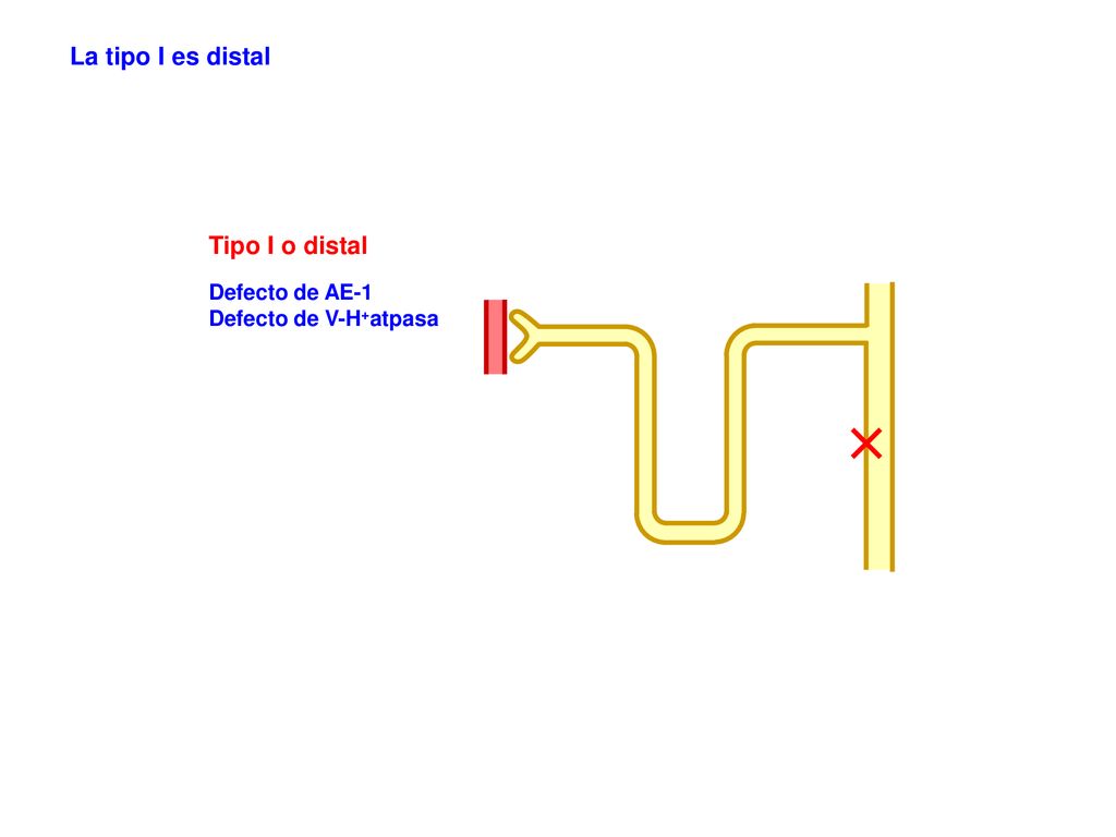 La tipo I es distal Tipo I o distal Defecto de AE-1
