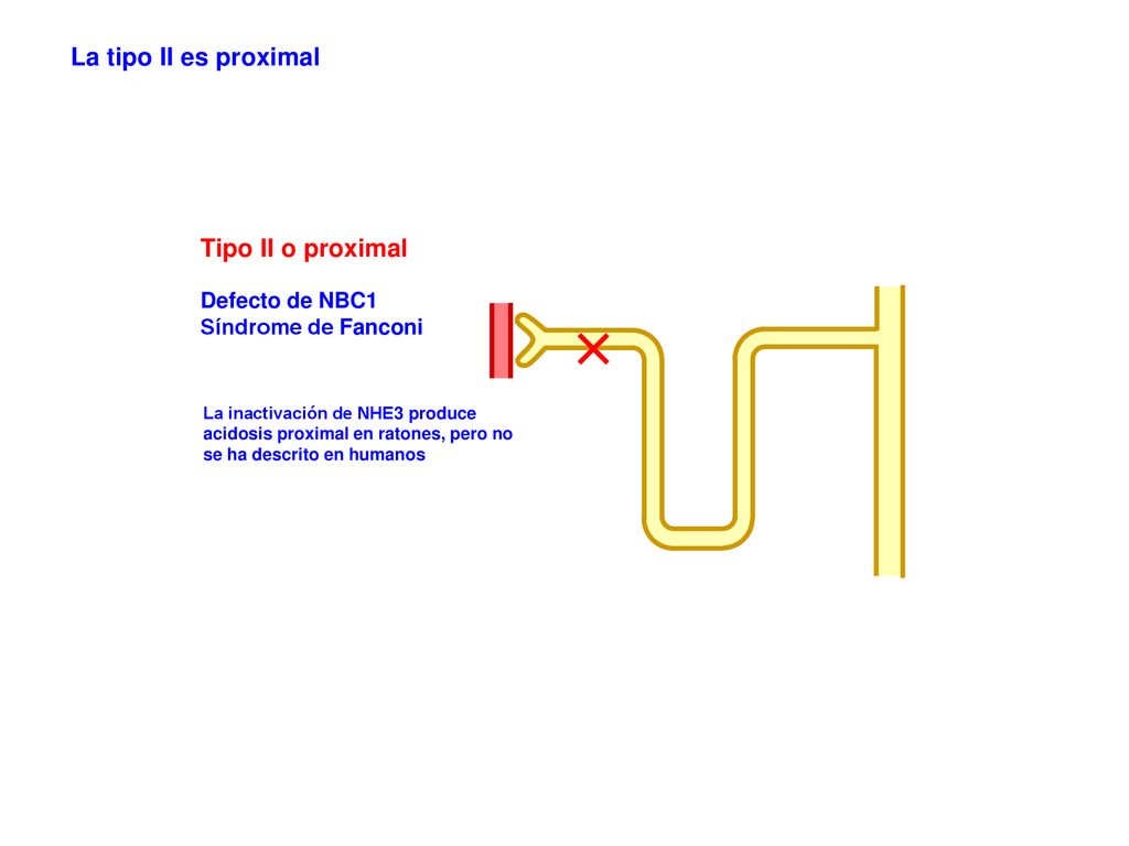 La tipo II es proximal Tipo II o proximal Defecto de NBC1