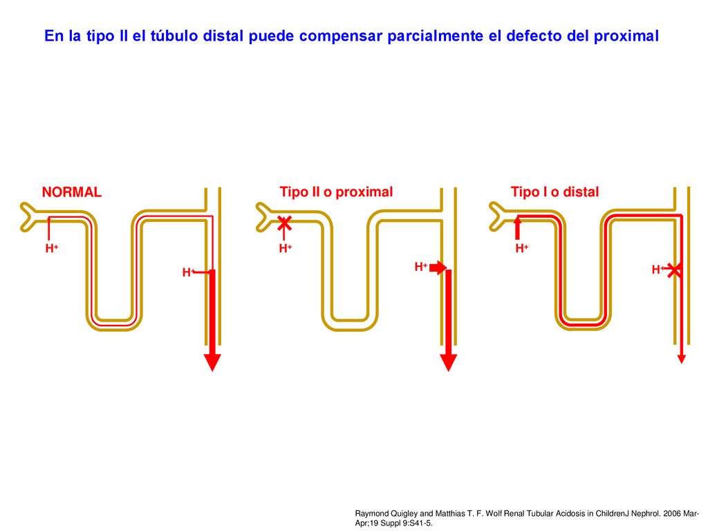 En la tipo II el túbulo distal puede compensar parcialmente el defecto del proximal