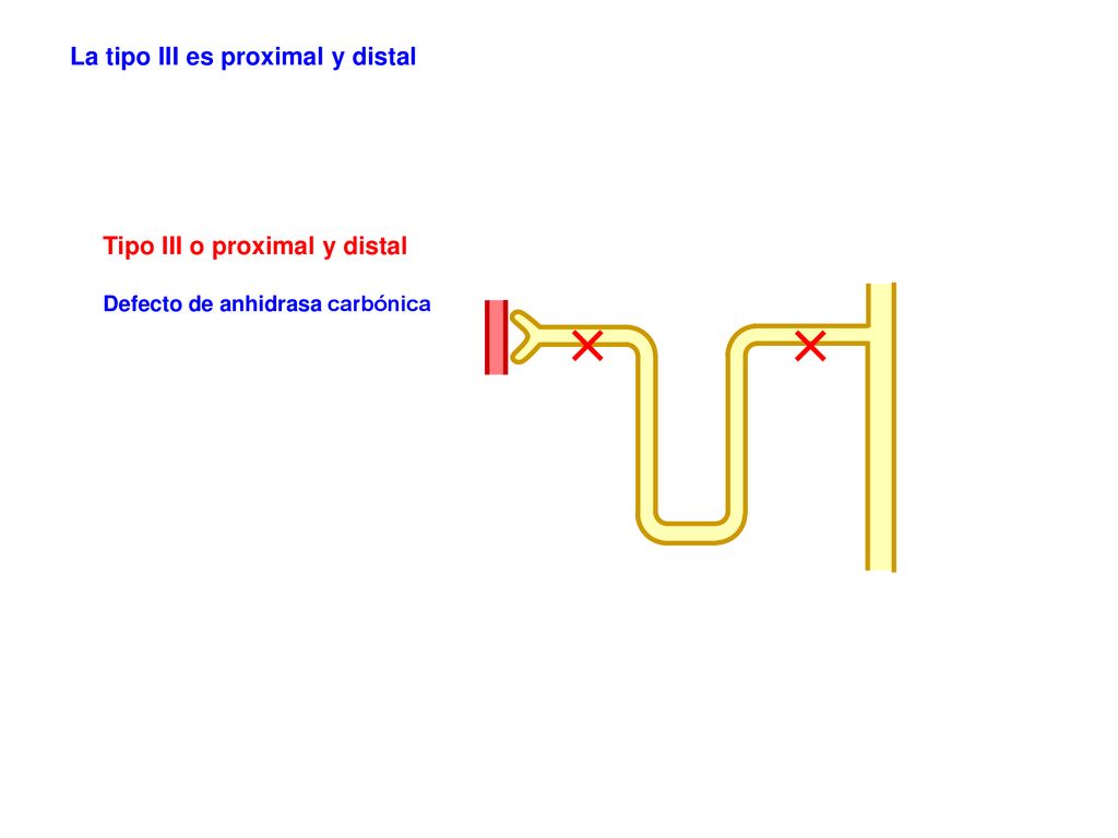 La tipo III es proximal y distal