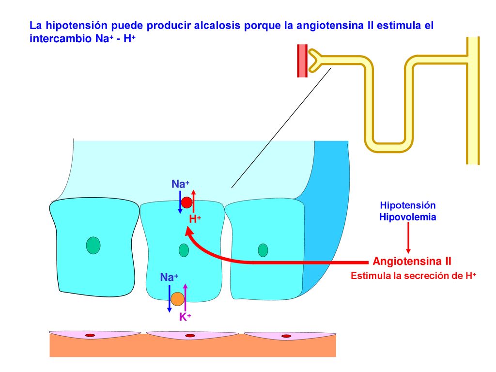 La hipotensión puede producir alcalosis porque la angiotensina II estimula el intercambio Na+ - H+