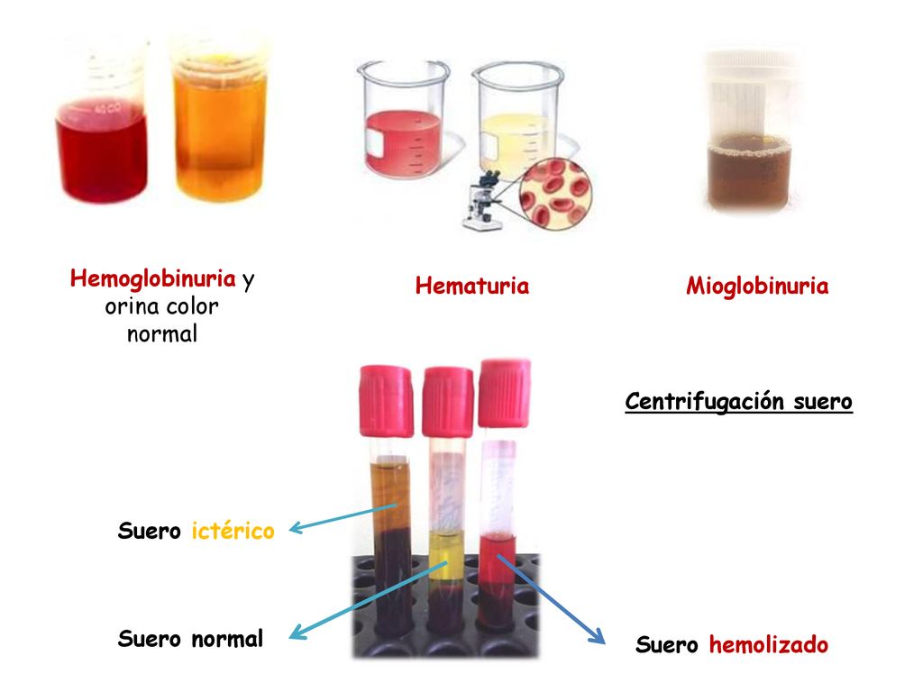 Hemoglobinuria y orina color normal