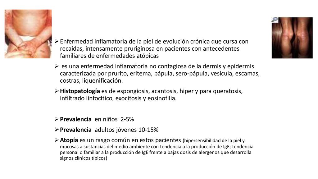 Enfermedad inflamatoria de la piel de evolución crónica que cursa con recaidas, intensamente pruriginosa en pacientes con antecedentes familiares de enfermedades atópicas