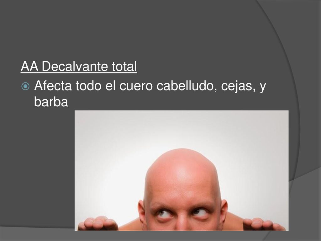 AA Decalvante total Afecta todo el cuero cabelludo, cejas, y barba