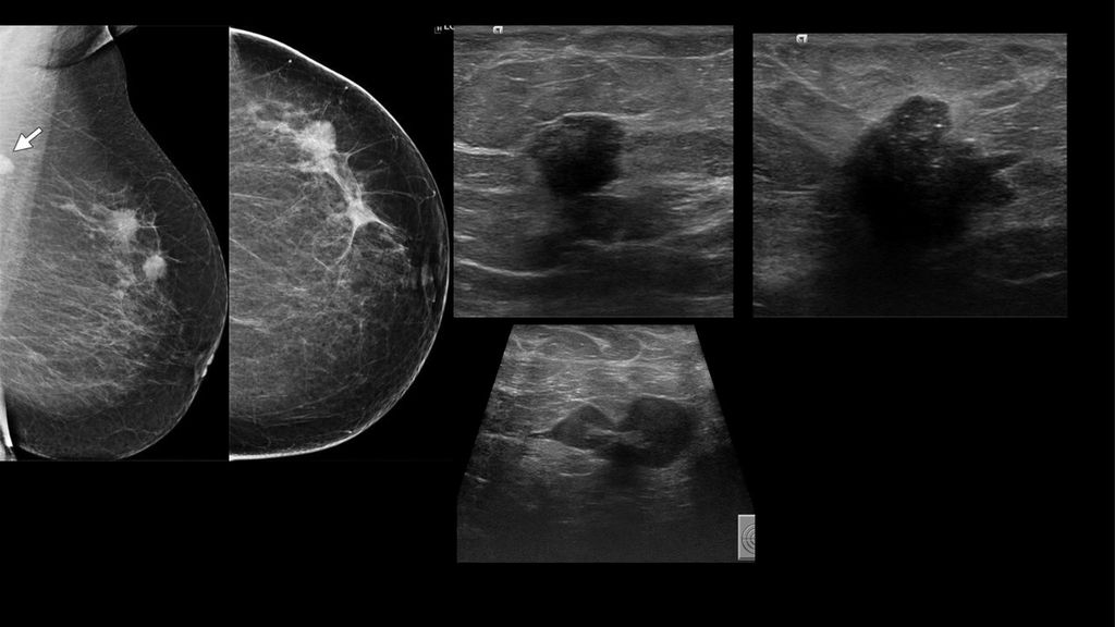 Figura 8e enfermedad multifocal ( estadio IIB, el tumor cT2N1M0 )