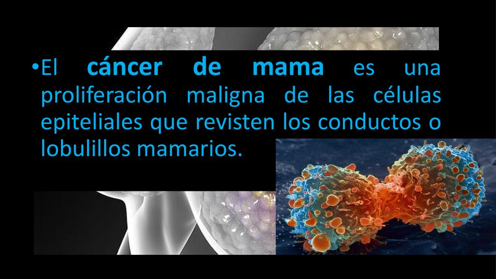 El cáncer de mama es una proliferación maligna de las células epiteliales que revisten los conductos o lobulillos mamarios.