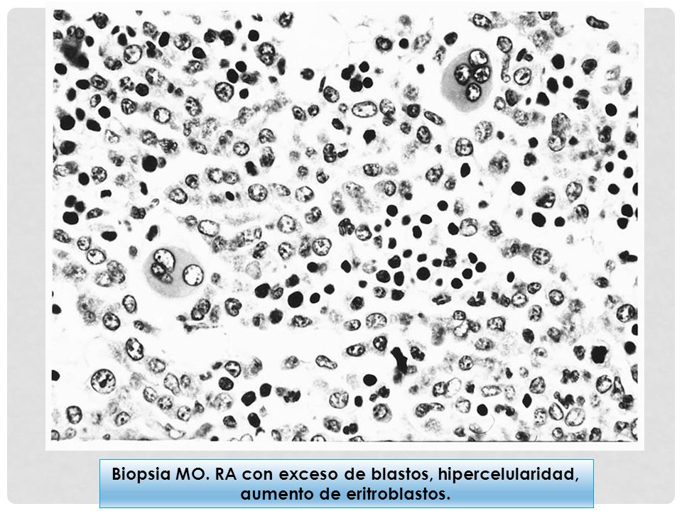 Biopsia MO. RA con exceso de blastos, hipercelularidad, aumento de eritroblastos.
