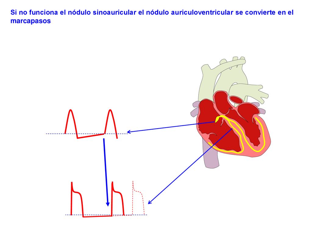 Si no funciona el nódulo sinoauricular el nódulo auriculoventricular se convierte en el marcapasos