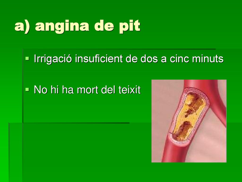 a) angina de pit Irrigació insuficient de dos a cinc minuts