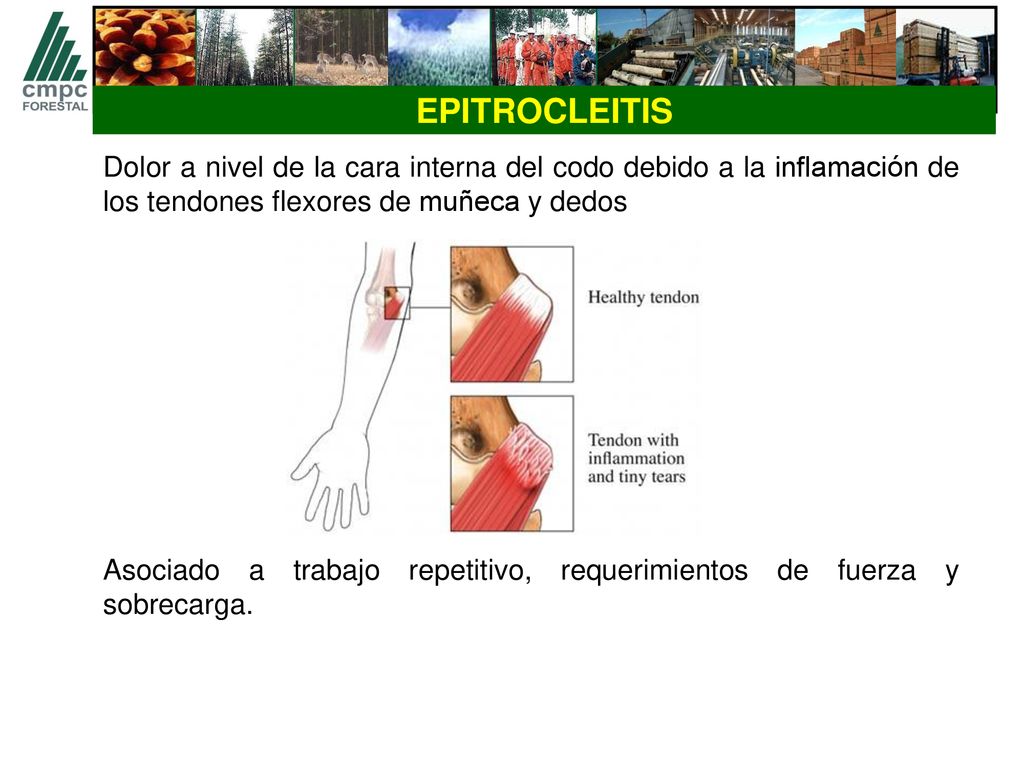EPITROCLEITIS Dolor a nivel de la cara interna del codo debido a la inflamación de los tendones flexores de muñeca y dedos.