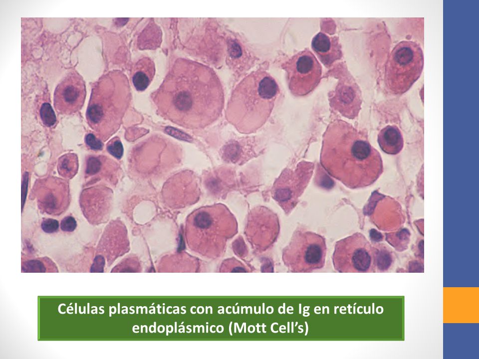Células plasmáticas con acúmulo de Ig en retículo endoplásmico (Mott Cell’s)