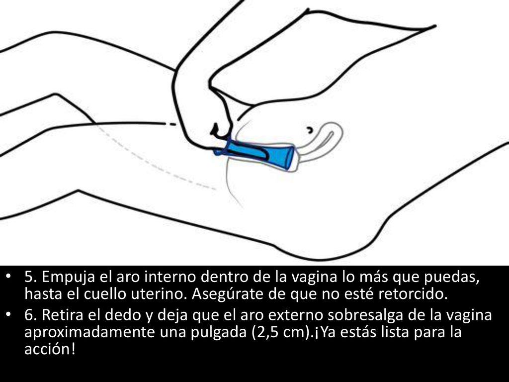 5. Empuja el aro interno dentro de la vagina lo más que puedas, hasta el cuello uterino. Asegúrate de que no esté retorcido.