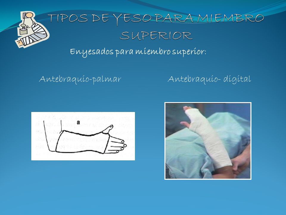 TIPOS DE YESO PARA MIEMBRO SUPERIOR